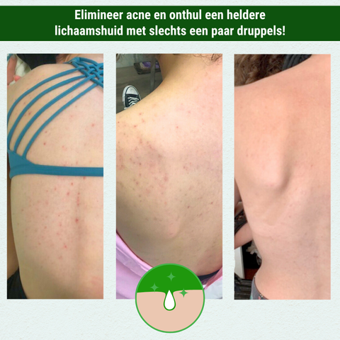 ReviSkin™ | Elimineer acne met slechts een paar druppels!