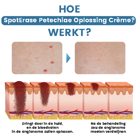 SpotErase™ | Crema per la rimozione delle petecchie 