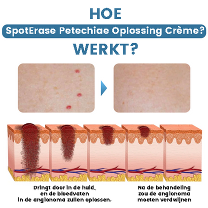 SpotErase™ | Crème Démaquillante Pétéchies 