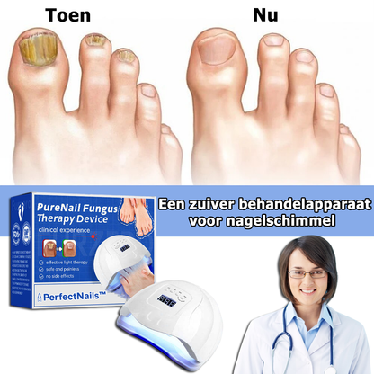 PerfectNails™ | Een apparaat voor de behandeling van nagelschimmel met een laser