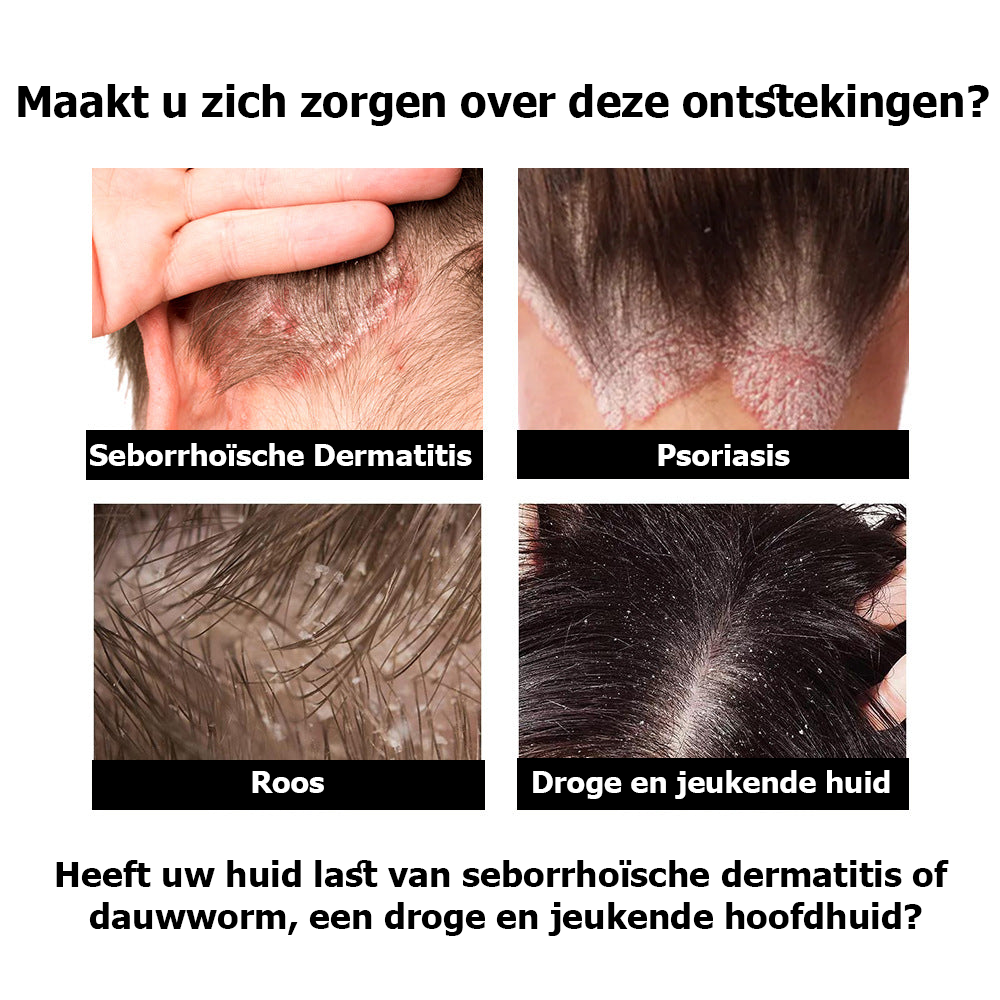 DermaHeal™ | Crème voor Seborrhoïsche Dermatitis