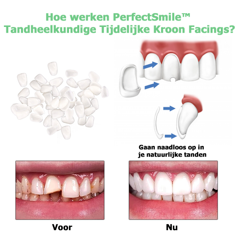 PerfectSmile™ | Tandheelkundige tijdelijke kroonfineer