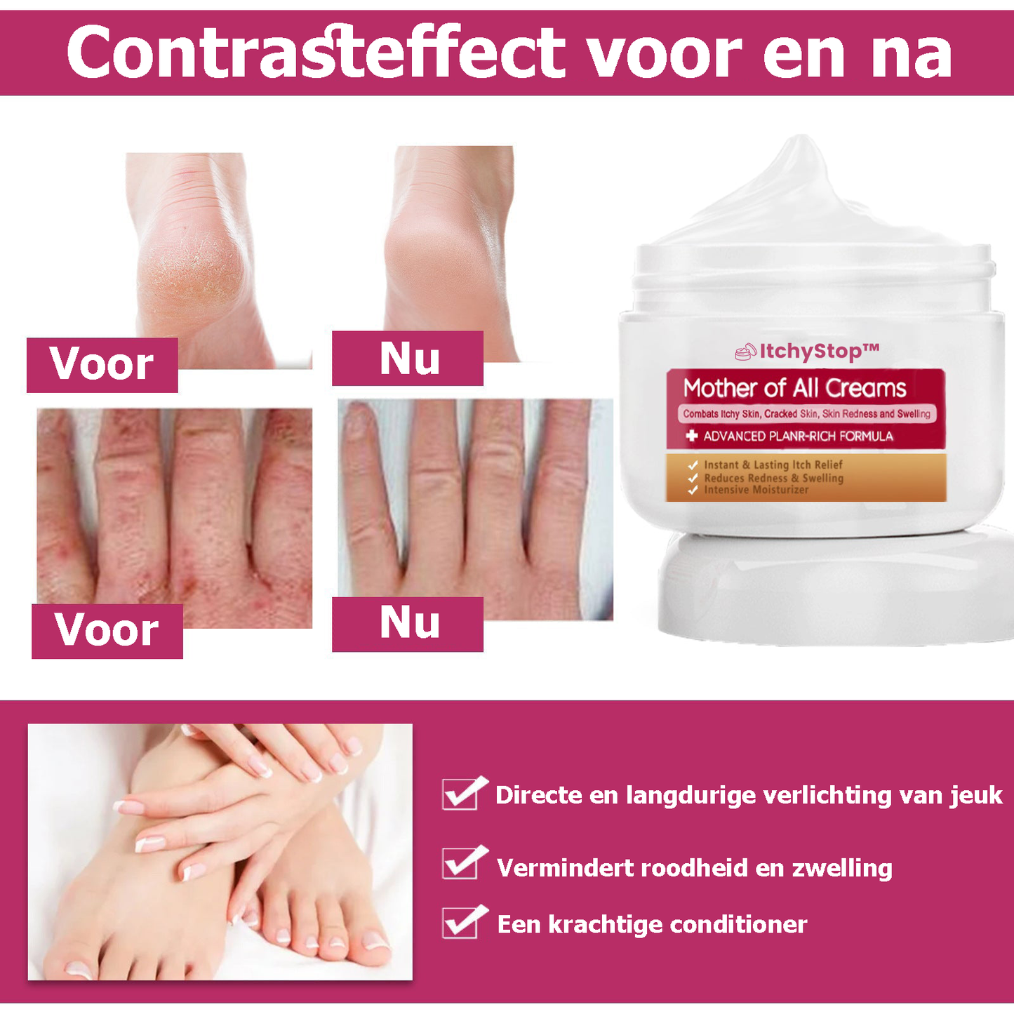 ItchyStop™ | Crème voor de behandeling van multi-symptomatische psoriasis