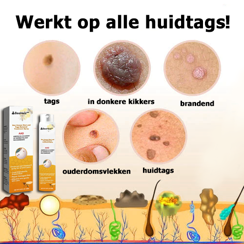 BeeHeal™ | Behandeling om moedervlekken en huidtags te verwijderen met bijengif