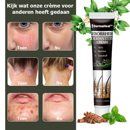 DermaHeal™ | Crème voor Seborrhoïsche Dermatitis