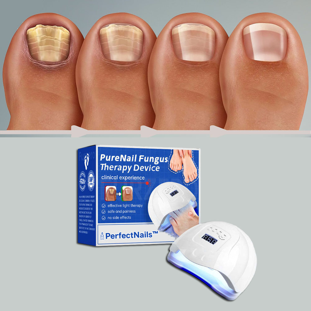 PerfectNails™ | Un dispositivo per il trattamento dei funghi delle unghie con un laser 