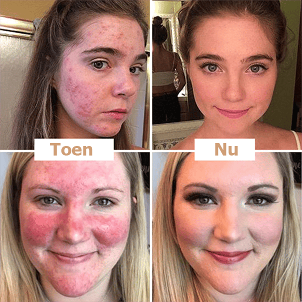 PerfectGlow™ | Krijg in seconden een vlekkeloze huid!