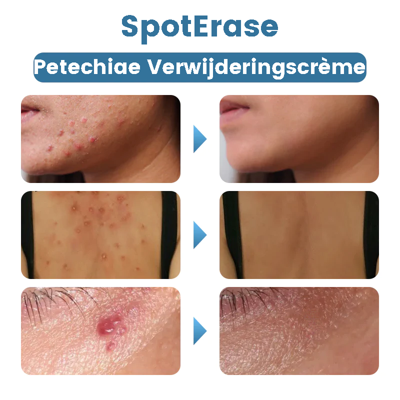 SpotErase™ | Crema per la rimozione delle petecchie 