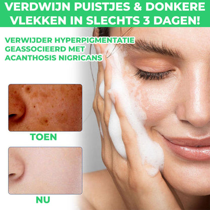 Dermacare™ | Reinigingslotion voor Acne & Vlekken