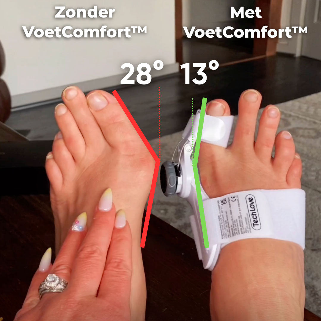 VoetComfort™ | Bunion Corrector Apparaat