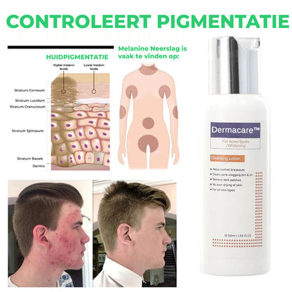 Dermacare™ | Reinigingslotion voor Acne & Vlekken