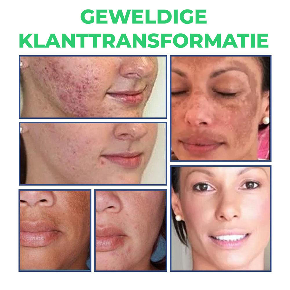 Dermacare™ | Reinigingslotion voor Acne & Vlekken