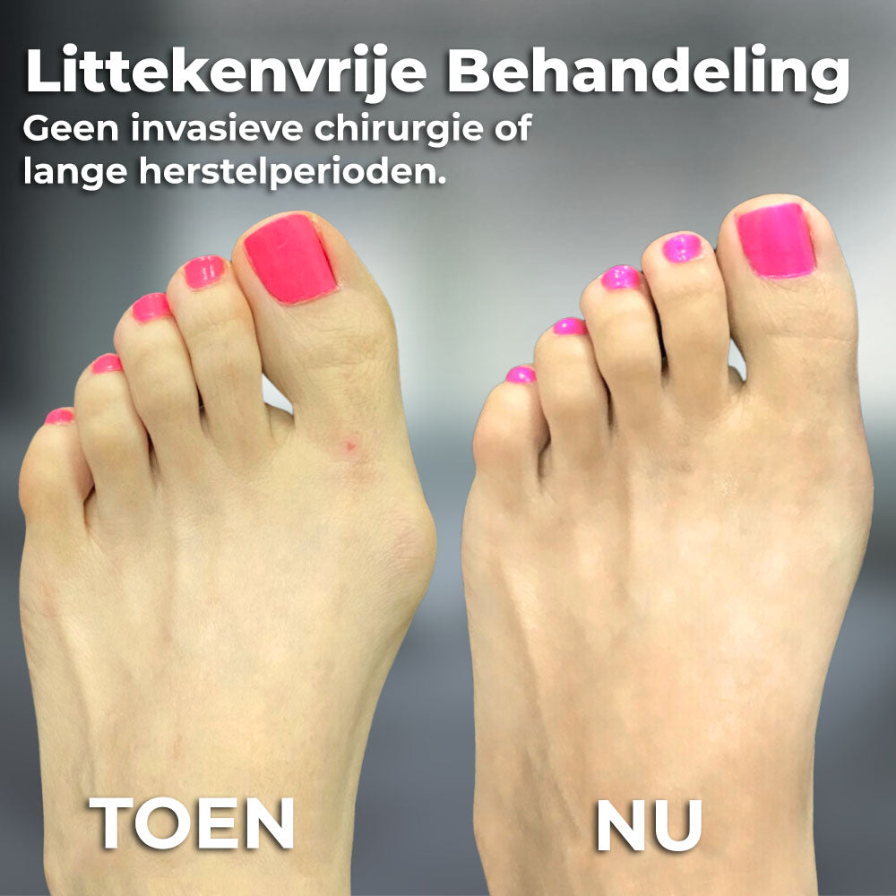 VoetComfort™ | Bunion Corrector Apparaat