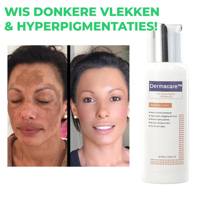 Dermacare™ | Reinigingslotion voor Acne & Vlekken