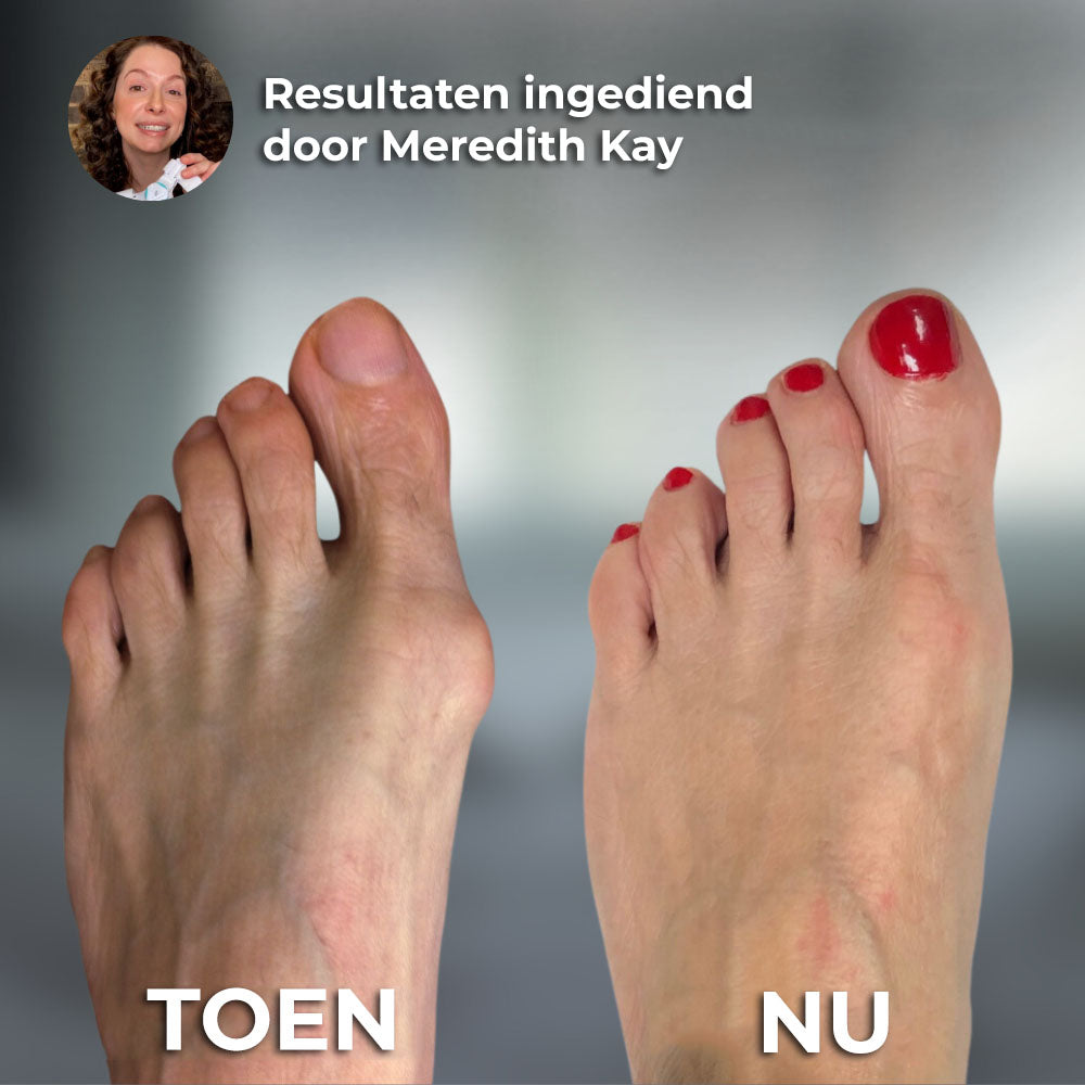 VoetComfort™ | Bunion Corrector Apparaat