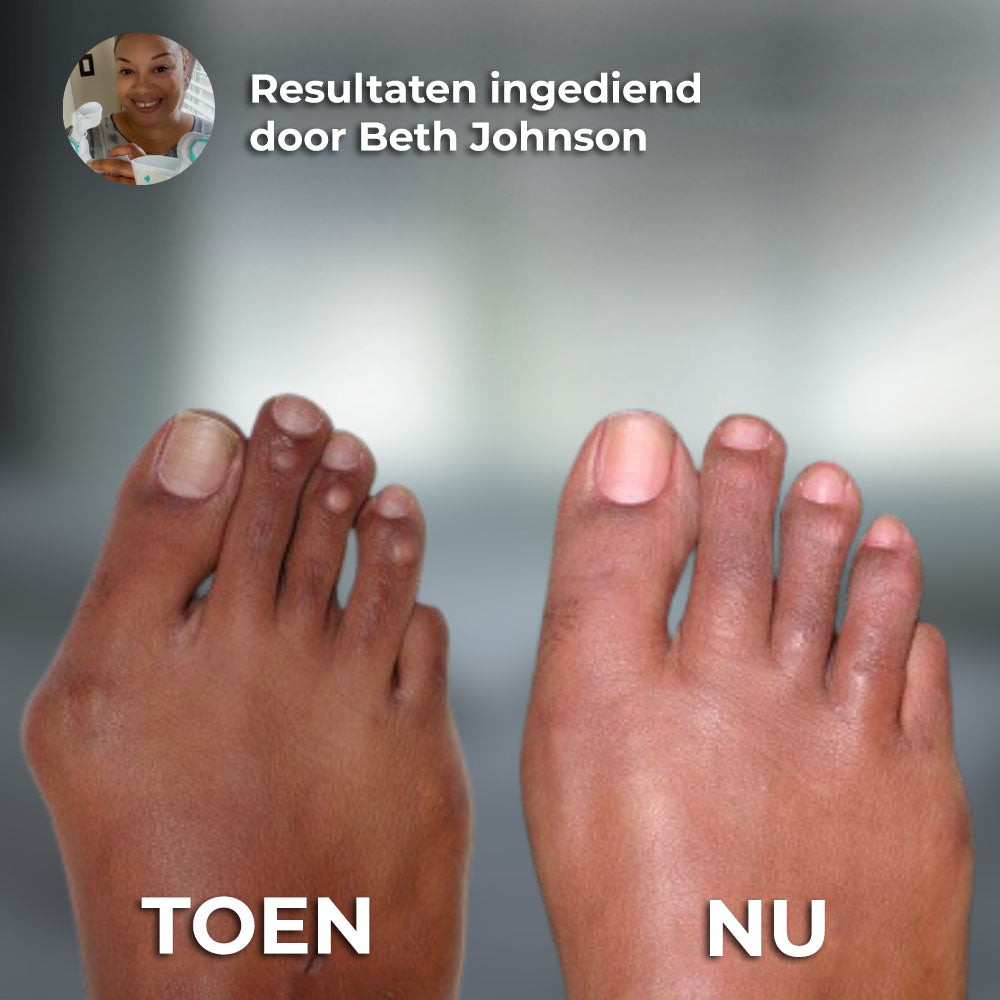 VoetComfort™ | Bunion Corrector Apparaat