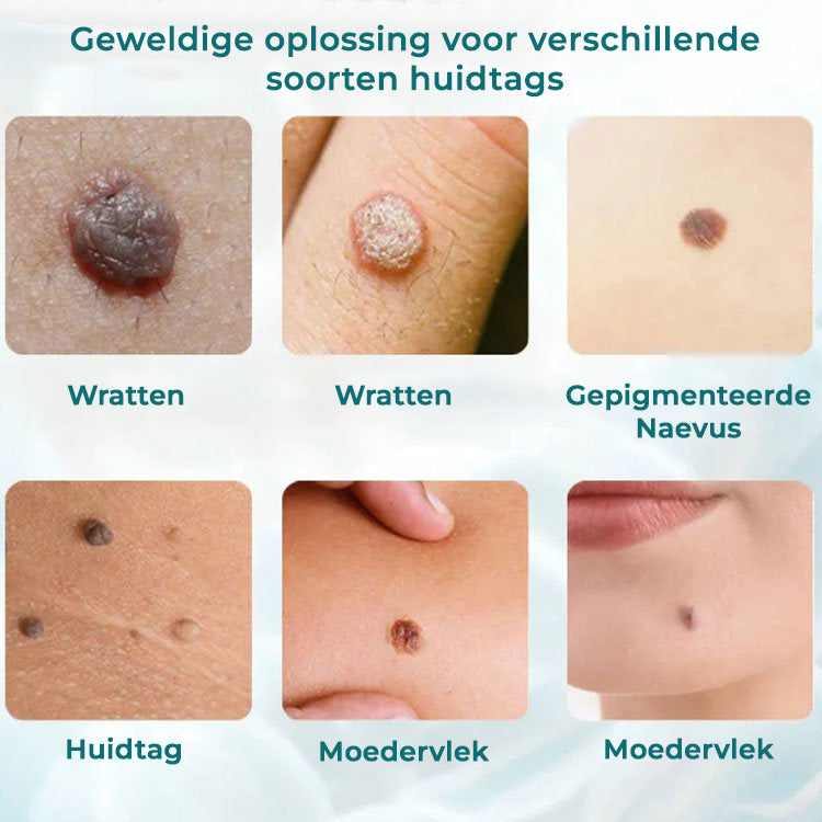 ClearSkin™ | Wrat, Moedervlek, Huidlabel Verwijderingscrème