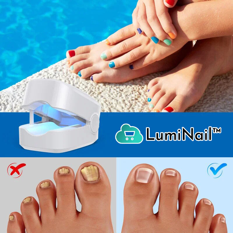 LumiNail™ | Hoogrendements Lichttherapie Apparaat Voor Teennagelziekten!